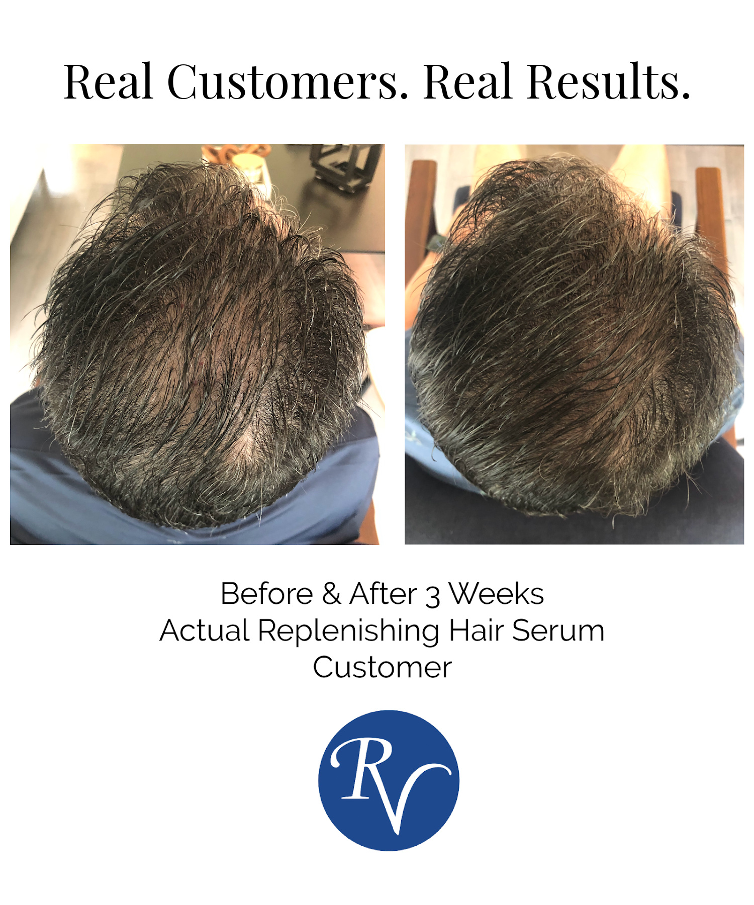 Treatment for Hair Loss | Replenishing Hair Serum with Redensyl® - Image 4
